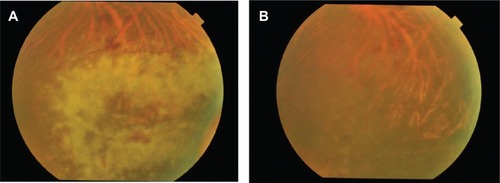 Figure 3 Fundus photographs of the left eye. (A) The retinal lesion did not resolve after intravitreous ganciclovir injection, and oral valganciclovir 1800 mg/day was initiated on June 28, 2011. (B) Resolution of retinitis was observed and valganciclovir was discontinued on August 20, 2011.