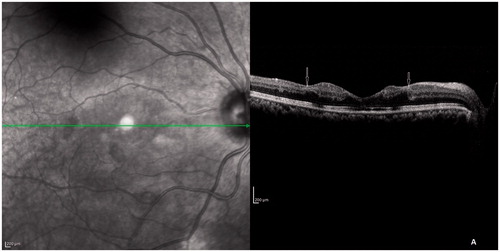 Figure 3. SD-OCT scan through fovea showing thickening of inner retinal layers and shadowing of outer retinal layers with a clear demarcation at the margin of widened foveal avascular zone (arrows). The ELM, IS-OS junction, and COST line were disrupted at the fovea.