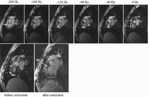 Figure 1. Images acquired at various frequency offsets using the frequency scouting sequence (top row), and images acquired using the 3D true-FISP sequence before and after correction of the frequency (bottom row). The 3D true-FISP image at the auto-adjusted frequency (before correction) shows substantial artifacts (dashed arrows). The frequency scout images acquired in a range of −200 Hz to 0 Hz indicate that the optimal frequency offset is −160 Hz because the blood pool is relatively uniform in the corresponding image. With a shift of −160 Hz in the imaging frequency, considerable reduction in the artifacts was observed in the 3D true-FISP image (after correction).