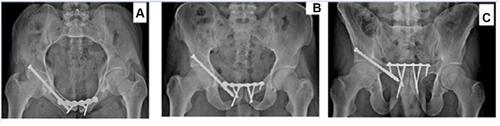 Figure 3 The post-op x-ray after fixation of the symphysis pubis with plating and right acetabulum with lag screw. (A) Inlet pelvic (B), Anteroposterior pelvic (C), Outlet pelvic x-rays.