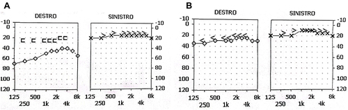 Figure 1 Conductive hearing loss on the right side. (A) Preoperative audiogram. (B) Postoperative audiogram after 2 months.