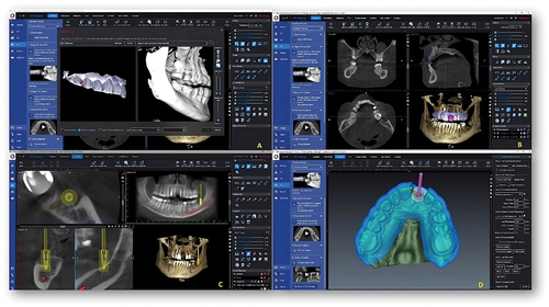 Figure 2. Showing the basic steps in virtual implant planning procedure. A-Mapping the intraoral scan with CBCT. B-Mapping of virtual crown with CBCT. C- position the implant using implant centric view. D- preparation of the virtual surgical guide.