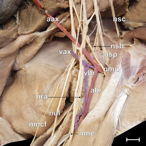 Figure 3. Photomacrograph of the medial surface of the right arm of an adult male specimen of Alouatta guariba clamitans, evidencing the relations between nerves and blood vessels. aax = axillary artery; abr = brachialis artery; nmcf = medial cutaneous of the forearm nerve; nme = median nerve; nmu = musculocutaneous nerve; nra = radial nerve; nsb = subscapularis nerve; nsc = subclavius nerve; nsp = suprascapularis nerve; nul = ulnaris nerve; vax = axillary vein; vbr = brachialis vein. Scale bar: 10 mm.