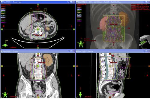 Figure 3 Radiotherapy planning to be delivered to bone metastases for this patient.