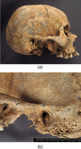 Fig 12 Exostoses in the external auditory meatus (EAE): (a) The skull of the female from grave 12, aged 25–30 years. Exostosis on the posterior wall of the right external channel; (b) Left temporal bone of the female from grave 25, aged 25–35 years. Exostosis on the posterior and anterior walls of the narrowed external auditory channel. Photographs by O Kozak.