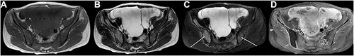 Figure 3 MRI showed abnormal signals of bilateral appendages, multiple small nodule shadows in greater omentum, lesser omentum and mesentery, abnormal signal shadows in pelvis, sacrum, thoracic vertebrae and lumbar vertebrae, effusion in abdominal, pelvic cavities. (A) T1WI, (B) T2WI, (C) STIR, (D) T1+ C. White arrow: iliac bone metastasis.