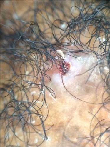 Figure 6 Tufted hairs with an area of loss of follicular ostia (×20).