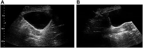 Figure 3 (A) Right ovary sagittal ultrasound image shows normal right ovary with no cysts after treatment. (B) Right ovary transverse ultrasound image shows normal right ovary with no cysts after treatment.