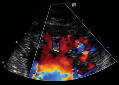 Figure 1. Echocardiographic appearance of IVNC. End-diastolic still frame (close-up view of LV apex) of a 37-year-old woman showing the typical echocardiographic features of IVNC with a thin epicardial and a thickened endocardial layer with prominent deep recesses. Blood flow from the ventricular cavity into the recesses is visualized with color Doppler. Reprinted from Steffel et al. (Citation12), Electrocardiographic characteristics at initial diagnosis in patients with isolated left ventricular noncompaction, American Journal of Cardiology 2009;104:984–89, Reprinted from American Journal of Cardiology, volume 104, Steffel J, Kobza R, Oechslin E, Jenni R, Duru F, Electrocardiographic characteristics at initial diagnosis in patients with isolated left ventricular noncompaction, pages 984–89, 2009 (Citation12), Copyright (2009), with permission from Elsevier.