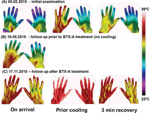 Figure 2. Thermography before and after treatment. Thermographic images of the hands taken on 3 different occasions. (A) the initial examination 05.02.2015; (B) follow up examination immediately prior to BTX-A treatment 19.05.2015 and (C) follow up examination after BTX-A treatment 17.11.2015. On the first and the third occasion, the patient’s hands was subjected to a mild cold provocation test (2-minute period of convective cooling using a desk top fan). The images were taken after the patient had had sat in the laboratory wearing warm clothes to ensure he was very mildly hyperthermic at the time of the examination. This was confirmed from the patient’s reported subjective feeling as well as from thermal facial images showing that the nose (open arterio-venous anastomoses) was vasodilated. The hand images were taken immediately after the patient arrived at the laboratory (on arrival), after the patient had been warmed up (prior cooling) and 3 minutes after the end of the cold provocation period (3 min recovery).