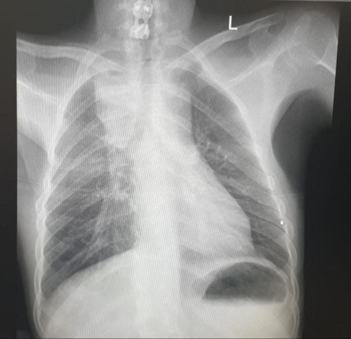 Figure 1 Standard PA chest x-ray demonstrating widened superior mediastinum with homogenous opacity seen in the right upper lung zone.
