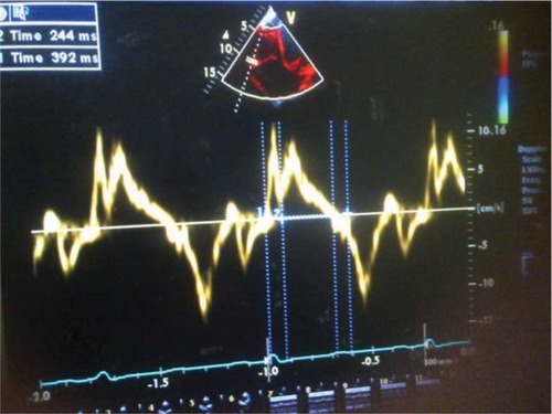 Figure 2 Abnormal RV MPI, 0.60 (1: TCO; 2:RVET) in subjects with HF.