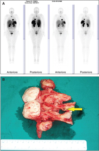 Figure 2. PET scan performed at the end of the fourth cycle of peptide receptor-targeted radionuclide therapy with 177Lu-DOTATATE (A). Gross section of surgical specimens with a circular dark area in the endocervix (yellow arrow) (B).