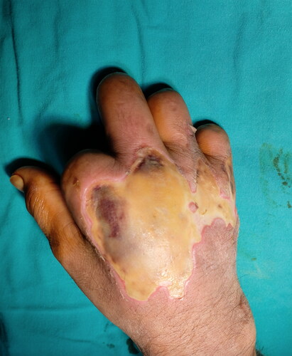 Figure 5. Full-thickness burns of the patient in his hand dorsum after exposure to the radiant heater. The patient had multiple amputations in different levels in his four extremities due to severe peripheral artery disease.