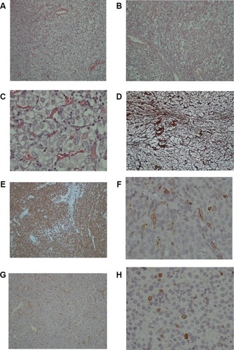 Figure 3 Histopathology and immunohistochemical staining, (A) Nests and sheets of polyhedral and round cells in a scanty amount of stroma with anastomosing vascular channels (H&E, X100); (B) In some foci, the tumoral cells are loosely cohesive with a myxoid stroma (H&E, X100); (C) The tumoral cells are round to polyhedral with uniform round to oval nuclei, focal nuclear pleomorphism, indistinct nucleoli and clear to pale eosinophilic cytoplasm with anastomosing capillary-sized vascular channels in between (H&E, X400); (D) Intratumoral reticulin deposition characterized by presence of reticulin fibres around nests of the cells and between tumoral cells with a cobwebby pattern(Reticulin stain, X100); (E) Diffuse cytoplasmic immunoreactivity of the tumoral cells for vimentin(Immunostaining, Anti-VimentinAb, X100); (F) Scatteredtumor cells show positive cytoplasmic reactivity for smooth muscle actin(Immunostaining, Anti Sm-Actin Ab, X400); (G) Immunostaining for CD34 highlights branching vascular channels(Immunostaining, Anti-CD34 Ab, X100); (H) Low proliferation capacity of the tumoral cells(Immunostaining for Ki67, MIB-1 clone, X400).
