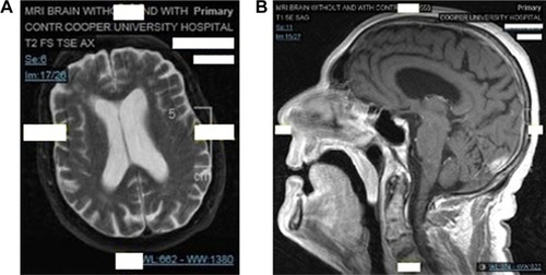 Figure 1 MRI of the brain with contrast.