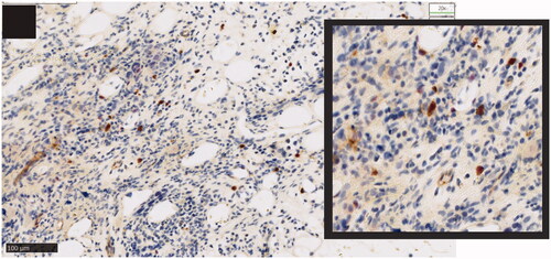 Figure 2. CD123 expression by immunohistochemistry in plasmacytoid dendritic cells in bone marrow biopsy of a patient with AML. Dual-color immunohistochemistry demonstrating membranous CD123 (brown) and nuclear TCF4 (red) staining; detailed section with ×20 magnification. AML: acute myeloid leukemia; TCF4: Transcription factor 4. Stemline Therapeutics, Inc. grants you non-exclusive permission to use the attached image in the article entitled ‘Targeting CD123 in hematologic malignancies: identifying suitable patients for targeted therapy’ authored by MM Patnaik, TI Mughal, C Brooks, R Lindsay, and N Pemmaraju and scheduled for publication in the journal entitled Leukemia & Lymphoma that is published by Informa Healthcare.