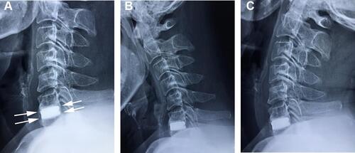 Figure 3 Plain radiographs obtained 4 years postoperatively. Lateral (A) imagings showed a complete radiographic fusion of the C6–C7 level with trabecular bone bridging surrounding the cervical disc prosthesis (arrows). No motion of C6–C7 was observed on flexion (B) and extension (C) imagings.