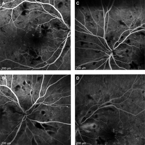 Figure 2 Fluorescein angiogram in early and late phases 12 hours post partum.