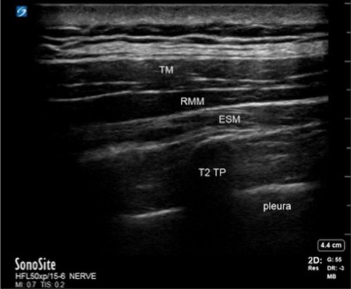 Figure 1 Ultrasound image of the three muscle layers.