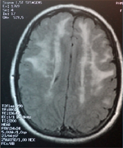 Figure 2 Magnetic resonance imaging scan of the brain (sagital section) showing hyperintensities involving white matter.