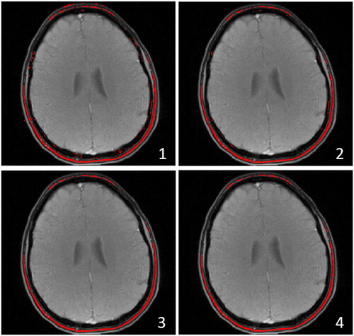 Figure A1. Example fat mask selection (of bone marrow) with volunteer 1, slice 1, (echo 1 of magnitude image), at time point 2. (1) Shows the initial mask, (2) eliminating fat-water swapped voxels, (3) including a signal threshold and (4) eliminating the residual outliers which is at the same time also the final fat mask. For this particular volunteer there were no residual outliers, so step 3 to 4 was superfluous.