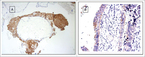 Figure 1. (A–F) Probability of survival correlated to expression of HLA-G and HLA-E, presented by Kaplan–Meier. Pathologic (X) or normal expression (•) in serous adenocarcinoma tumor cells. (A) HLA-G in the total cohort N.S. (B) HLA-G in worst prognosis group (HLA-A*02) p = 0.0003. (C) HLA-G in otherwise group (HLA-OW) N.S. (D) HLA-E in the total cohort p = 0.003. (E) HLA-E in worst prognosis group (HLA-A*02) p = 0.0003. (F) HLA-E in better prognosis group (HLA-OW) N.S.