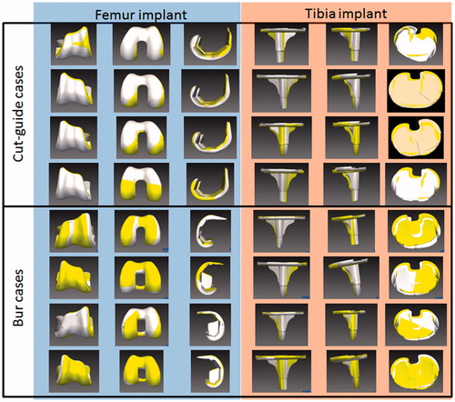 Figure 9. Overlay of planned (yellow) and actual (white) implant positions for 8 cases.