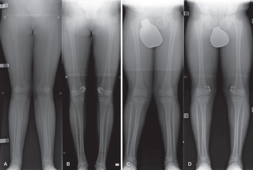 A. Genu valgum prior to medial stapling of the distal femoral physes.B. Before removal of implants.C. Genu valgum prior to medial hemiepiphysiodesis of the distal femoral physes using the tension-band plating technique.D. Correction of genu valgum before removal of implants.