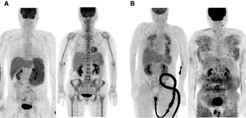 Figure 2 MIP FDG PET/CT images of representative IVLBCL patients of the EN/DS3-4 group. (A) A 56-year-old patient with spleen involvement (left) and a 64-year-old patient with bone marrow involvement (right). (B) A 57-year-old patient with lung bone marrow and spleen involvement (left) and a 61-year-old patient with skin and subcutaneous involvement (right).