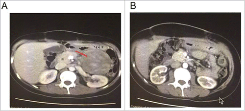 Figure 1. CT image of initial diagnosis (A); CT image of post resection(B).