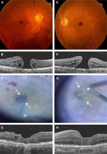 Figure 1 Representative two cases (Case 1, A–D; Case 2, E–H) with old-large macular hole treated with pars plana vitrectomy and inverted internal limiting membrane (ILM) flap technique.