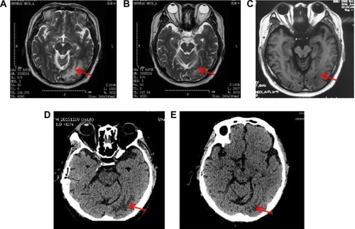 Figure 3 Cranial MRI showing the encephaledem in the occipital lobe of the head (A), encephaledem obviously alleviating (B), slightly worsening after suspension of apatinib for 6 days (C), the encephaledem basically under control as shown by CT every 2 months (D and E).