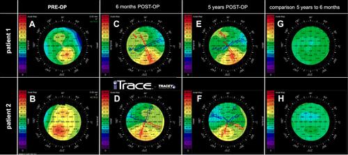 Figure 5 Corneal topography of two patients (one eye from each patient) who had undergone combined photorefractive keratectomy and corneal crosslinking for the correction of their refractive error. Axial maps preoperatively (A and B), 6 months postoperatively (C and D), 5 years postoperatively (E and F) and comparative maps showing postoperative stability up to last follow-up (G and H).