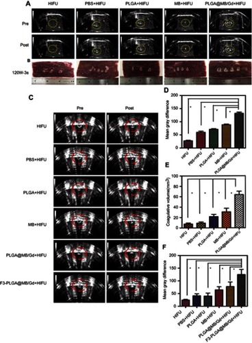 Figure 6 (A) B-mode ultrasound images of degassed bovine livers before and after HIFU exposure at 120 w, 3 s. (B) Digital photos of degassed bovine livers under HIFU irradiation after intra-tissue injection of various agents: PBS, PLGA, MB, PLGA@MB/Gd. (C) B-mode ultrasound images of MDA-MB-231 tumor tissues before and after HIFU exposure at 120 w, 3 s. (D) The mean grey difference calculation based on the ultrasound imaging of bovine liver tissue after various treatment. (*P<0.05). (E) The calculated coagulation volume of bovine liver tissue after HIFU treatments (*P<0.05). (F) The mean grey difference calculation based on the ultrasound imaging of MB-231 tumor tissue after HIFU treatment (*P<0.05).Abbreviations: B-mode, brightness-mode; HIFU, high intensity focus ultrasound; PBS, phosphate buffer saline; PLGA, poly(lactide-co-glycolic acid); MB, methylene blue; Gd, gadodiamide.