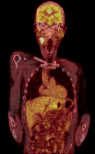 Figure 2 PET/CT scan of a patient with proven IgG4-related pancreatitis, cholangitis, and periaortitis.