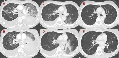 Figure 1 Chest computed tomography images. (A and B) At the initiation of trastuzumab deruxtecan (T-DXd) treatment. Every lesion recurred rapidly. (C and D) Eleven days after T-DXd treatment. All lesions shrank in size in response to T-DXd treatment. (E and F) Six months after T-DXd treatment. All lesions remained shrunken in response to T-DXd treatment. Response of tumor was assessed partial response by RECIST Ver 1.1.