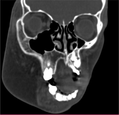 Figure 4 CT scan showing the enlarged maxilla.