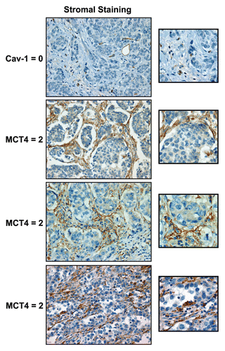 Figure 1 Cav-1 and MCT4: stromal staining in human breast cancer patients. Note the high expression of MCT4 in the tumor stroma and cancer-associated fibroblasts in a subset of TN breast cancer patients, which is associated with a loss of stromal Cav-1 (Table 2). Representative images of patients in the stromal high-risk groups are shown (Cav 1 = 0 and MCT4 = 2). Despite a loss of stromal Cav-1 immunostaining, blood vessels remain Cav-1-positive, as endothelial cells are resistant to oxidative stress. Original magnification, 40x.