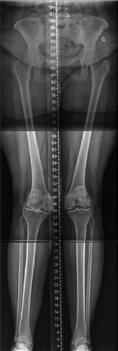 Figure 4. Lower limb long radiographs showing a case with an LDFA of 11° and MPTA of 6°. Reproducing her lower limb alignment with KA technique (unrestricted) would leave her lower limb HKA in 5° of valgus. With rKA, correcting the femur to 5° and the tibia to 2° of varus would results in an HKA of 3° valgus.