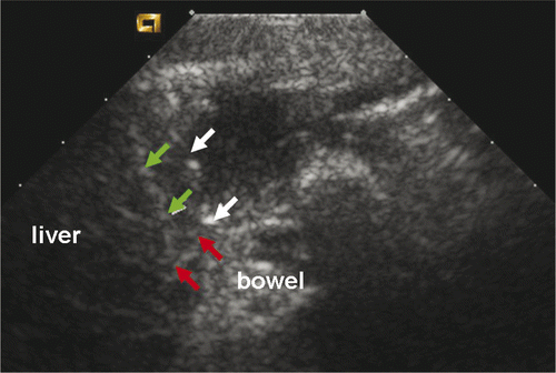 Figure 1. Microwave ablation under ultrasound guidance: the linear hyperecho (white arrow) showed the tip of the thermal needle was under the liver capsule (red arrow) and the right linear hyperecho (green arrow) was the microwave needle.
