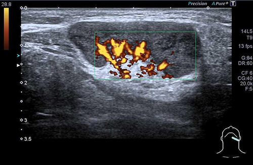 Figure 2 Ultrasound of a 30-year-old woman with cervical nodal enlargement shows an enlarged lymph node with hilar hypervascularity. Lymph node biopsy revealed Kikuchi histiocytic necrotizing lymphadenitis.