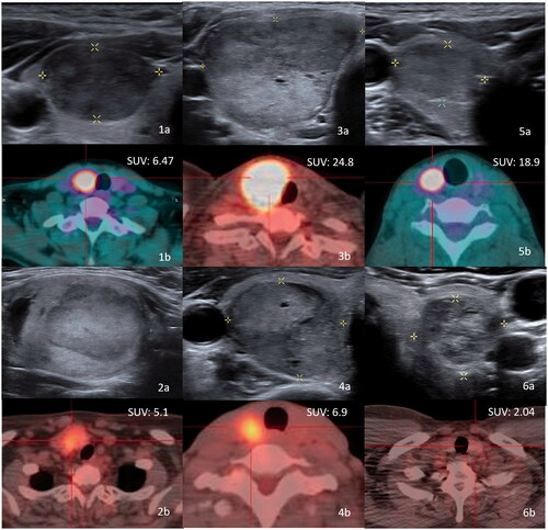 Figure 2. (1a–5a) Sonography of five patients with thyroid follicular neoplasm who underwent surgery. The pathologies were: papillary carcinoma (1a); follicular tumor with uncertain malignant potential (2a); Hurthle cell carcinoma (3a); Hurthle cell carcinoma (4a); and Hurthle cell adenoma (5a). One patient with follicular neoplasm underwent RF ablation (6a). The Bethesda classifications were category IV in all 6 patients. Photographs of PET/CT of six thyroid follicular neoplasms (1b–6b). The SUVmax values are shown.