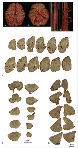 Figure 4 (see next page). Macroscopic findings from the brain and spinal cord. The whole brain (A, B), and cervical (C), and lumbar spinal cord (D) before fixation. Serial coronal sections of the left hemisphere (E), axial sections of brainstem (F) and cerebellum (G). Macroscopic analysis showed temporal and mild frontal lobe atrophy, predominantly in the left temporal lobe (A, B). The spinal anterior root was atrophic (C, D). In the coronal serial sections of left hemisphere, temporal and mild frontal cortical atrophy were evident (E). The inferior olivary nuclei and the cerebellum were not atrophic (F, G).