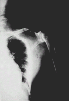 Figure 3. X-ray showing complete disappearance of calcification after successful renal transplantation.