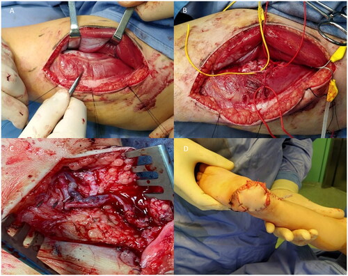 Figure 2. Intraoperative photos. (A) The perforator of the descending branch of lateral circumflex femoral artery is shown between rectus femoris and vastus lateralis muscle. (B) The perforator is isolate. (C) Anastomosis. (D) Suture of the flap.