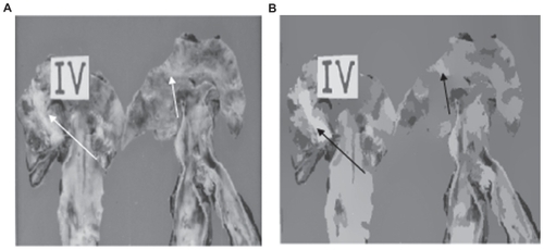 Figure 1 (A) Original image and (B) unsupervised segmentation using our algorithm. The arrows mark the isolated lesions.