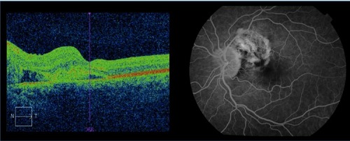 Figure 2 Optical coherence tomography showing left macular edema secondary to subretinal hemorrhage (left); fluorescein angiography of left fundus showing peripapillary choroidal neovascular membrane (right).