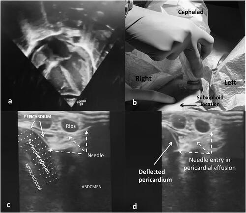 Figure 1. (a) Pericardial effusion and echogenic mass in the right atrium; apical 4-Chamber view, low-frequency neonatal cardiac probe. (b) Ideal alignment of the linear probe in a long-axis plane in the subxiphoid location. (c) The needle tip (dashed arrow) directed to penetrate subcutaneous tissues and pericardial tissue (white arrow) under real-time ultrasound guidance. (d) Needle advancement in the pericardial space and deflected pericardium till entry in pericardial sac. 