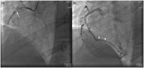 Figure 1. Coronary angiography showing (a) proximal dissection of the right coronary artery and (b) reperfusion after proximal drug-eluting stent placement.
